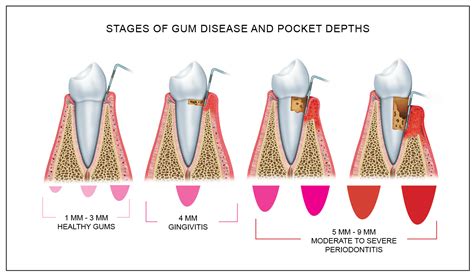 periodontal near me|Periodontal diseases .